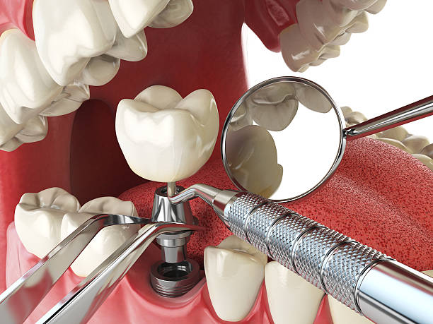 Best Emergency Dentist for Knocked-Out Tooth in Warren Af, WY